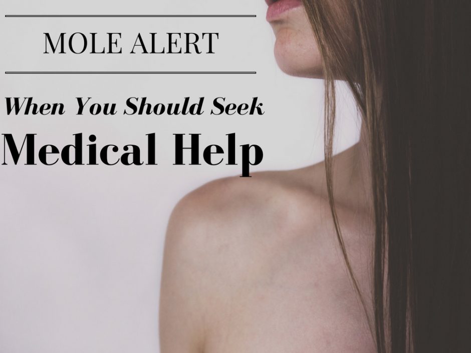 Mole Alert - When you Should Seek Medical Help.