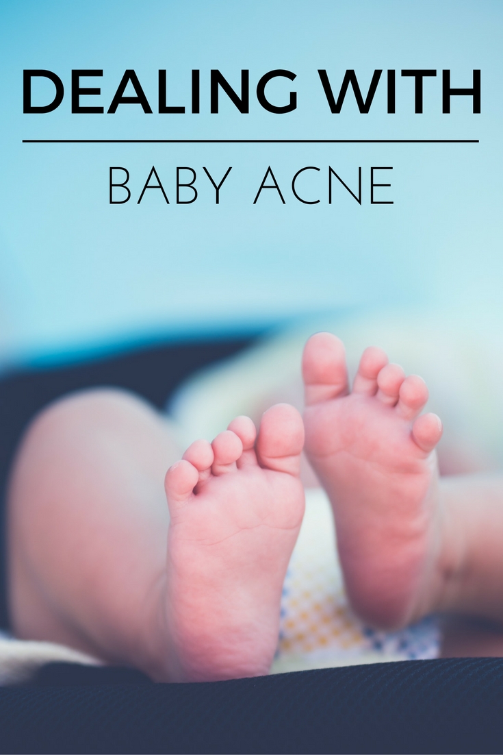 How to Treat Baby Acne
